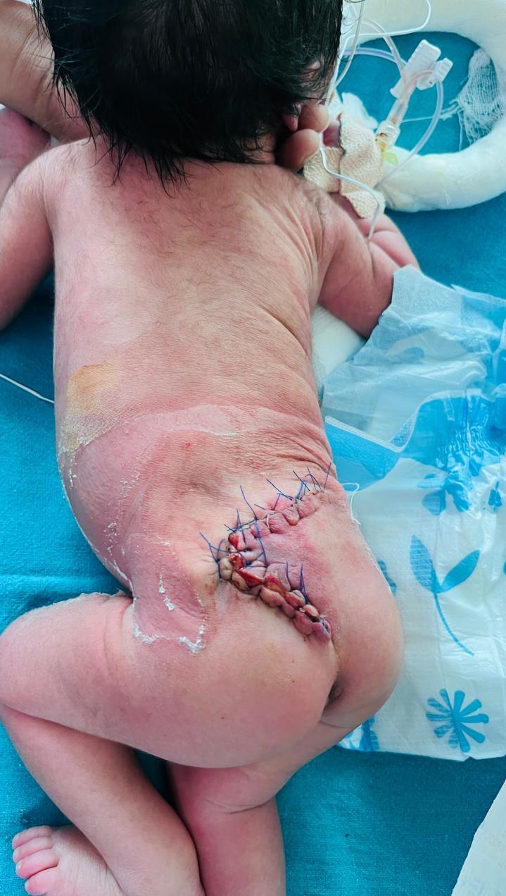 इंटीग्रल हॉस्पिटल में एक दिन के नवजात शिशु की दुर्लभ न्यूरोलॉजिकल स्थिति की सफल सर्जरी